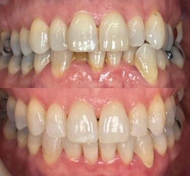 Invisalign case 4