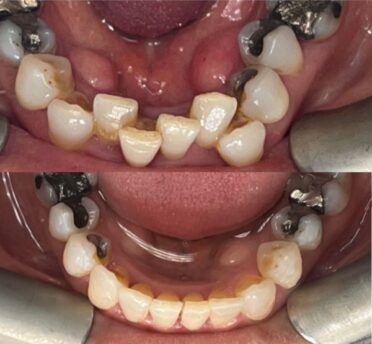 Invisalign case 5
