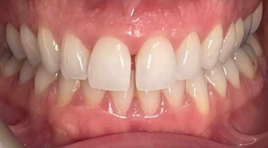 Smile Makeover Case 1 before