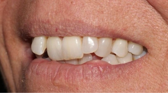 Teeth Straightening Case 3 before