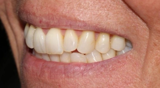 Teeth Straightening Case 3 after