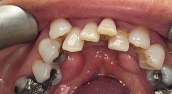Teeth Straightening Case 4 before