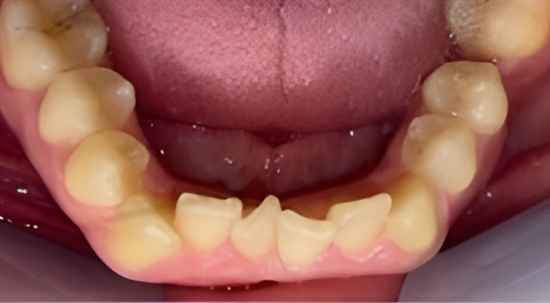 Teeth Straightening Case 5 before
