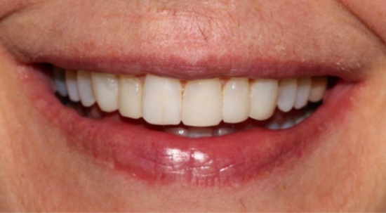 Smile Makeover Case 2 after