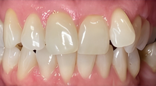 Teeth Straightening Case 7 before