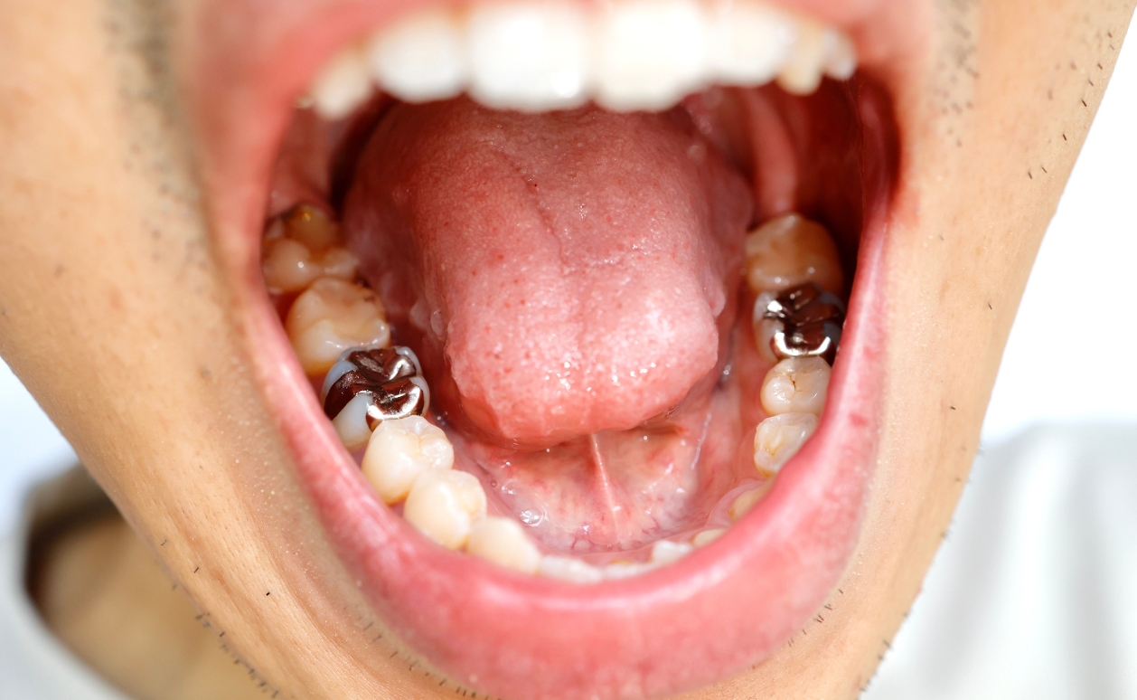 Amalgam (silver) fillings