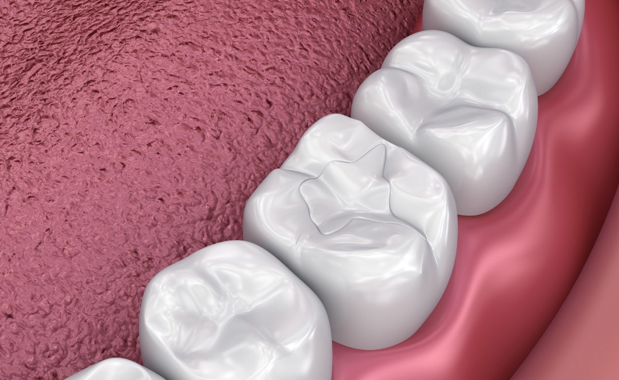 Composite (white) fillings