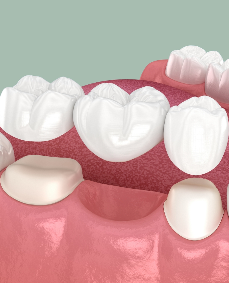 Dental Bridges
