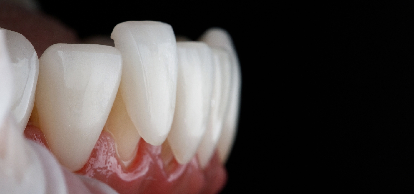 Veneers