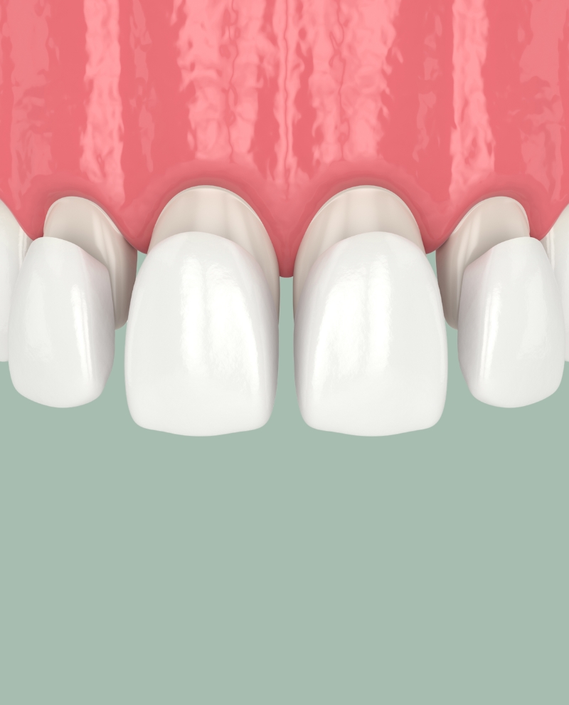 Veneers