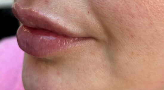 Facial Aesthetics Case 1 after