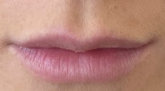 Facial Aesthetics Case 2 before